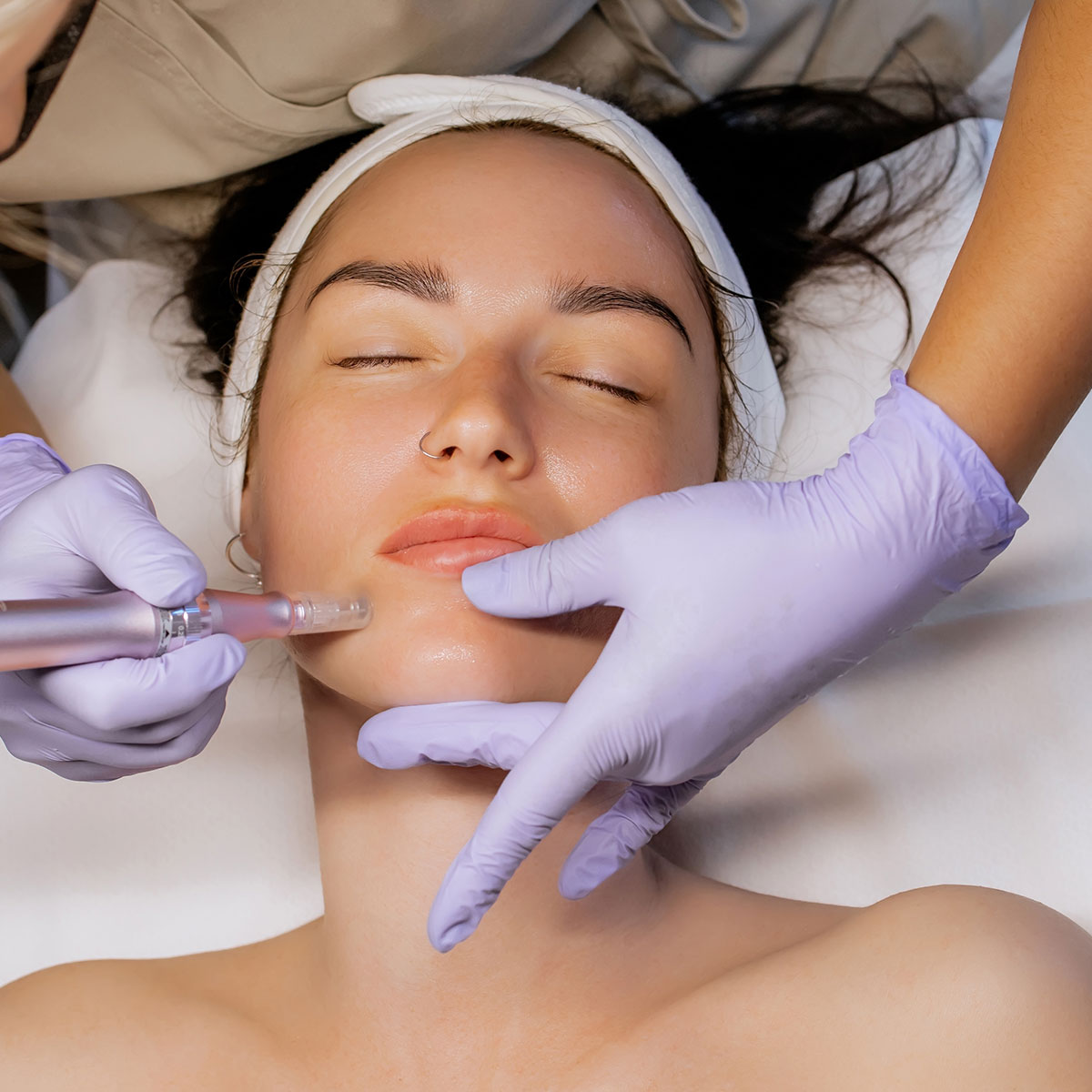 Microneedling with PRF and fillers